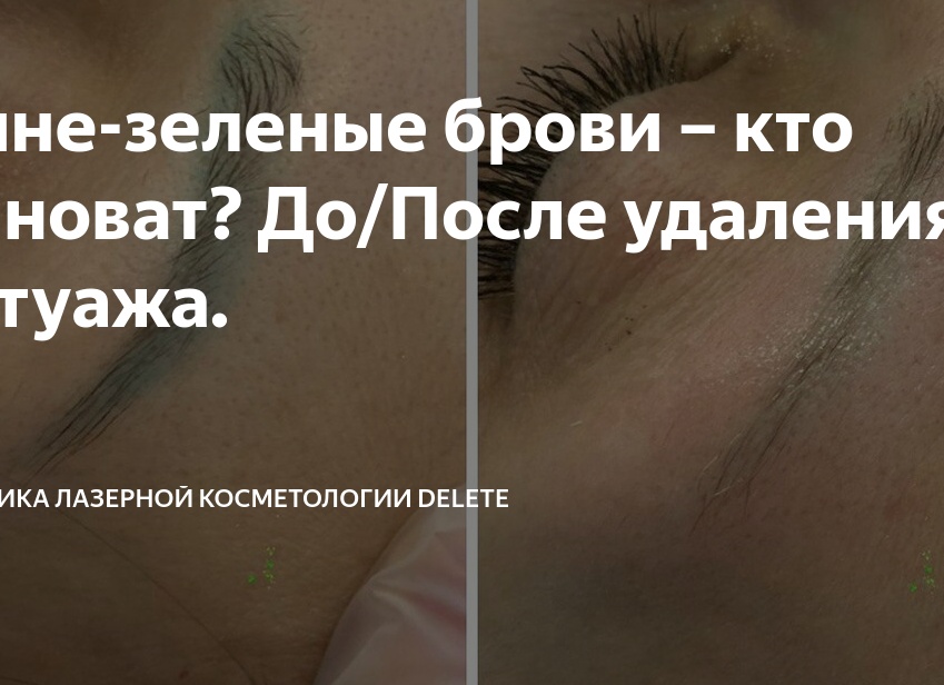 Сине-зеленые брови – кто виноват? До/После удаления татуажа.