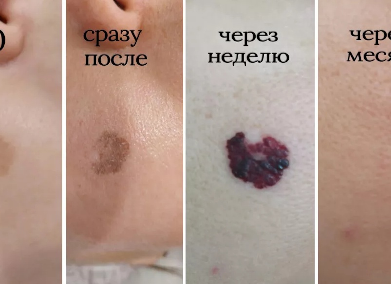 Идеальный лазер для удаления пигментных пятен
