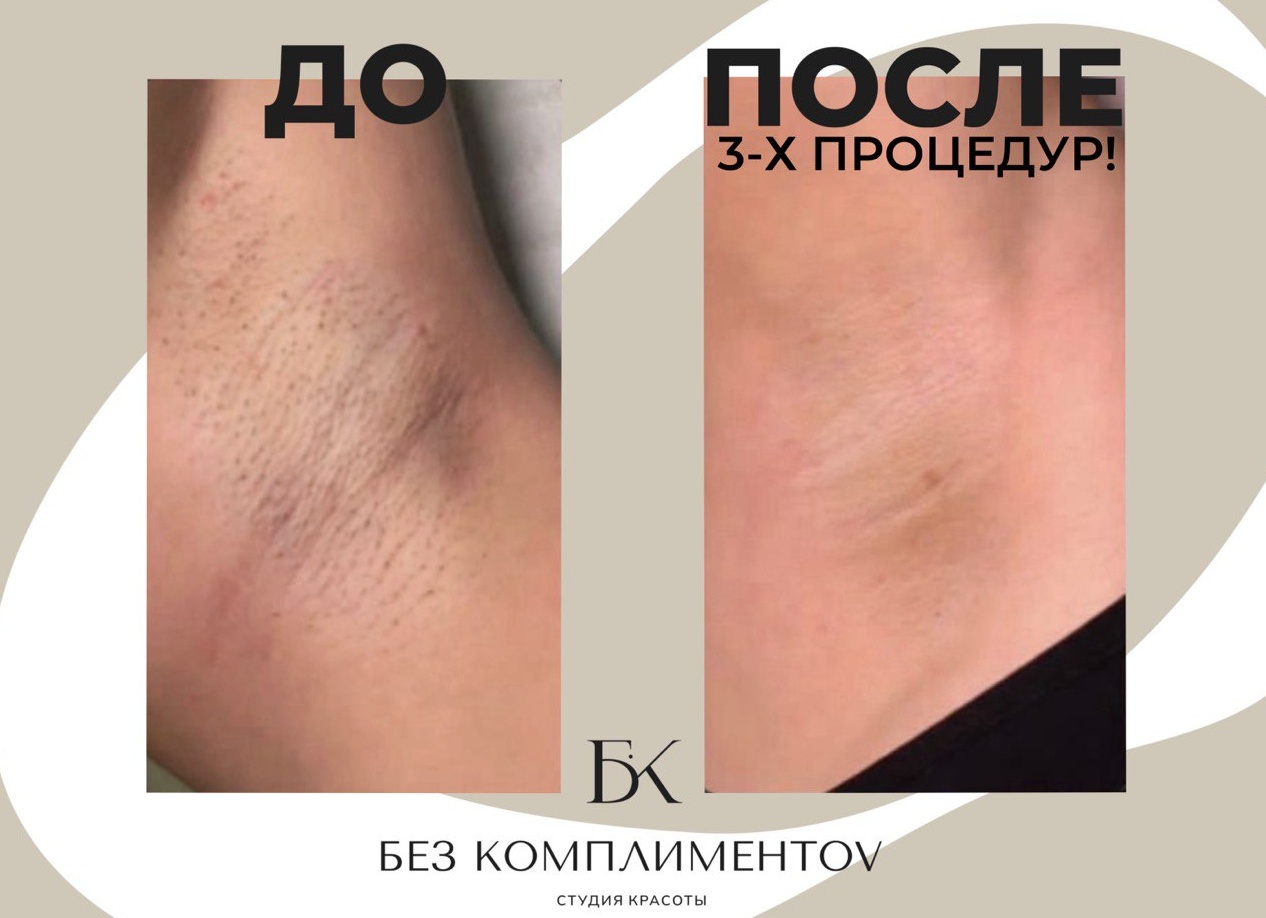 «Как ухаживать за кожей после лазера, чтобы не было рубцов?» Пошаговые рекомендации специалистов Delete.