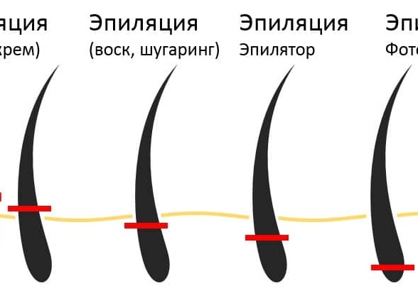 Лазерная эпиляция vs электроэпиляция: какую технологию предложить клиентам в 2025 году?