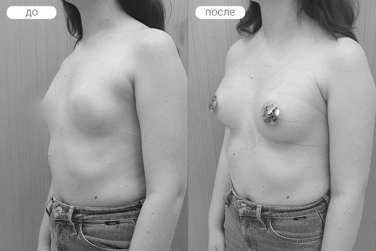Пациентка М. Выполнено увеличение груди имплантами motiva 245cc подгрудным доступом