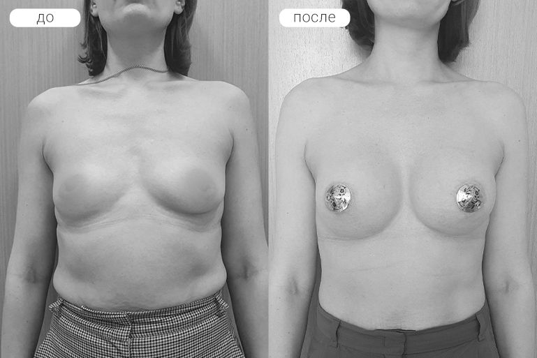 Пациентка Ю. Выполнено увеличение груди имплантами silimed 275cc через ареолу.